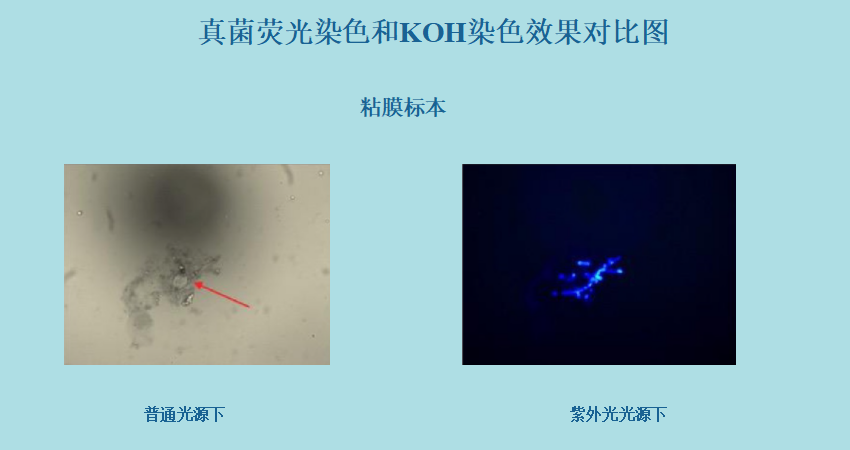 真菌荧光染色液和KOH染色效果-临床对比(图4)