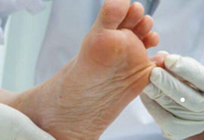 真菌染色剂品牌提示有时候脚丫痒有脱皮现象并不是得了脚气