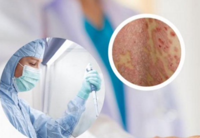 用什么方法可以判断皮肤是否被真菌感染