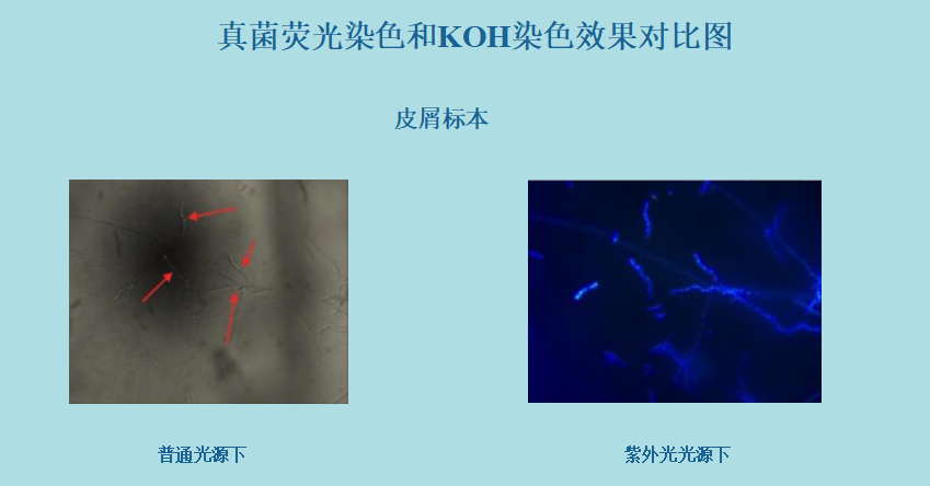 真菌荧光染色液和KOH染色效果-临床对比(图2)