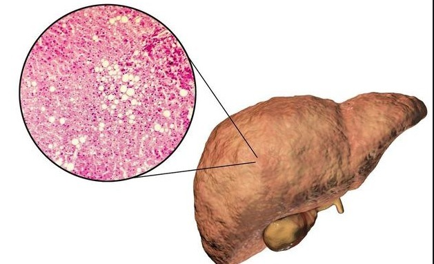 真菌免疫荧光染色剂厂家为您解读脂肪肝是怎么来的，并不是喝酒才得脂肪肝